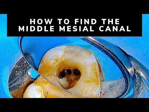 How To Retreat A Mandibular Molar (Limited To The Mesial Root)