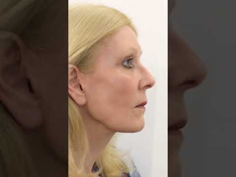 FACELIFT TRANSFORMATION IN