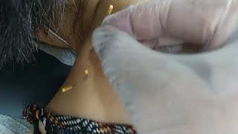 Dry needling for Upper trapezius trigger points