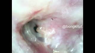 ugly right middle ear canal endoscopy checkup post mastoidectomy surgery