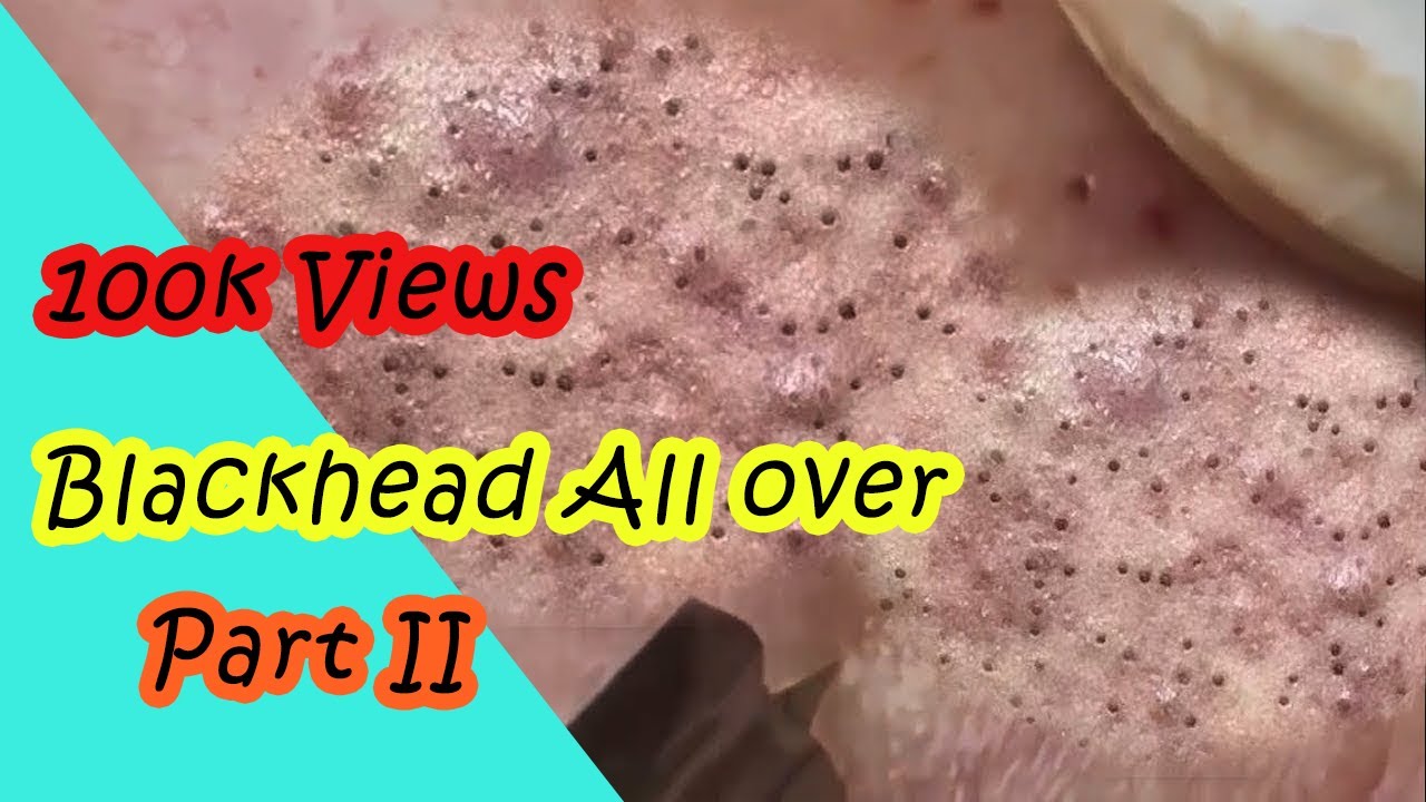 OMG removal of extreme blackhead never seen before part 2 😱😱 YouTube
