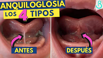 ¿Todos tienen la lengua atada al nacer?