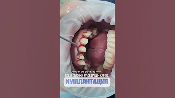 После обточки зубов нашли кариес. After turning the teeth, caries was found.