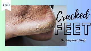 Cracked feet causes and treatment.