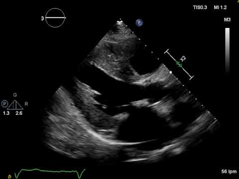 Vídeo: La Amiloidosis Relacionada Con La Transtiretina Autosómica Dominante (TTR) No Es Una Neuropatía CMT2 Frecuente 