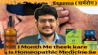 My Experience | Homeopathic Medicine for Eczema | 100% Effective |