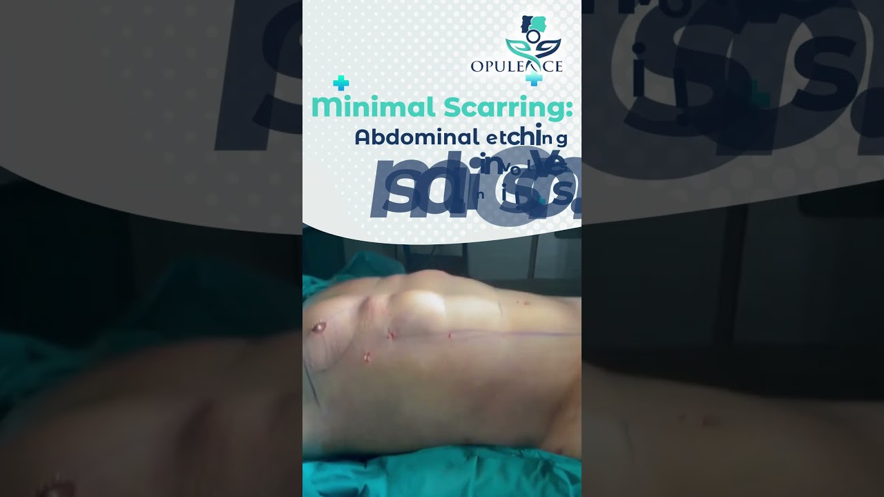 Benefits of Abdominal Etching I Advantages of High Def Lipo ( High Definition Liposuction).