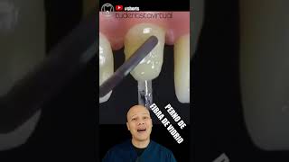 Como Se Hace Un Perno O Endoposte Correctamente Paso A Paso