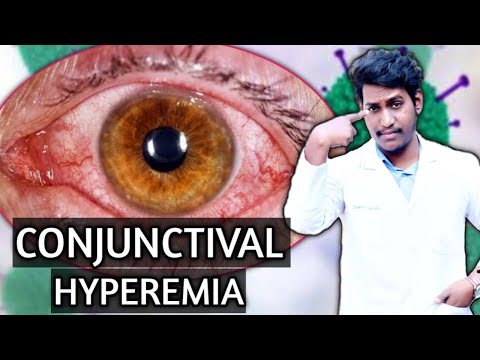 conjunctival hyperemia ||hyperemia in hindi ||hyperemia and congestion pathology ~2021