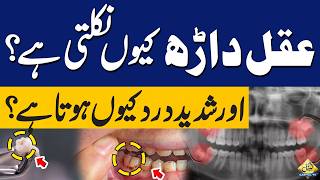 Why Wisdom Teeth Erupt & Cause Severe Pain? | Real Reason Explained Simply | Capital TV