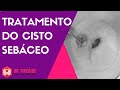 Tratamento do cisto sebáceo - Dr Jônatas Catunda