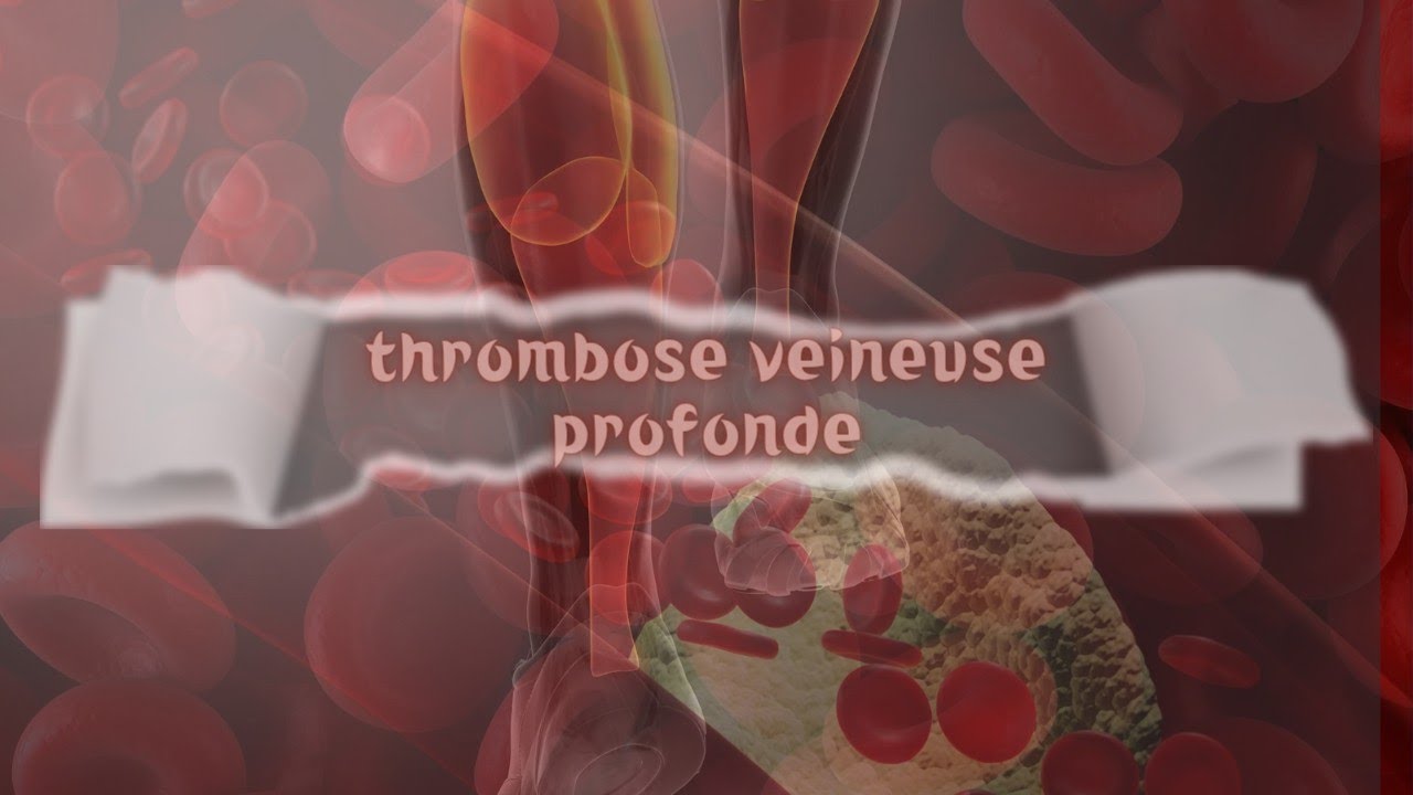 La thrombose veineuse profonde YouTube La thrombose veineuse profonde YouTube