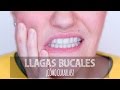 Llagas en la boca: ¿por qué salen y cómo curarlas? - explicación Dra. Georgina Carbajo