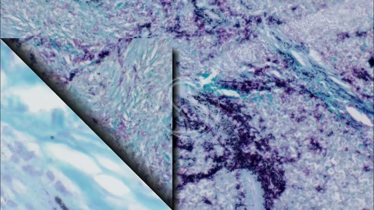 Actinomycosis in Liver with Gram Twort Staining - YouTube
