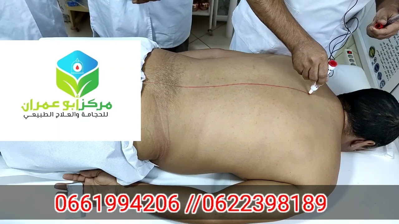 حصة تعليمية لنقاط الحجامة على الشبابيك الخلفية للعمود الفقري #الحجامة_بمكناس  0661994206