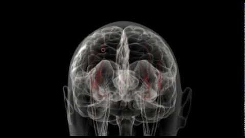 Boezemfibrilleren waarbij een CVA wordt veroorzaakt