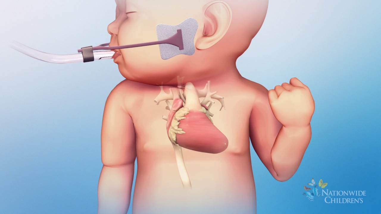 Hypoplastic Left Heart Syndrome (Hlhs): Hybrid Stage One Procedure