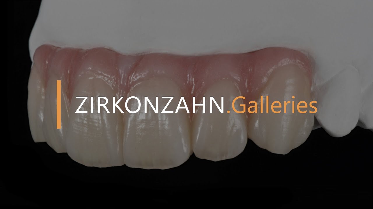 Prettau® zirconia – ﻿Screw-retained, six-unit anterior restoration | Zirkonzahn.Galleries