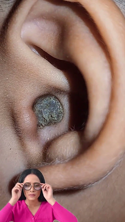 Satisfying relaxing asmr earclining earwax removal