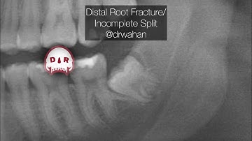 Distal Root Fracture During Wisdom Tooth Extraction. Root tip Pick Used for Retreival @drwahan