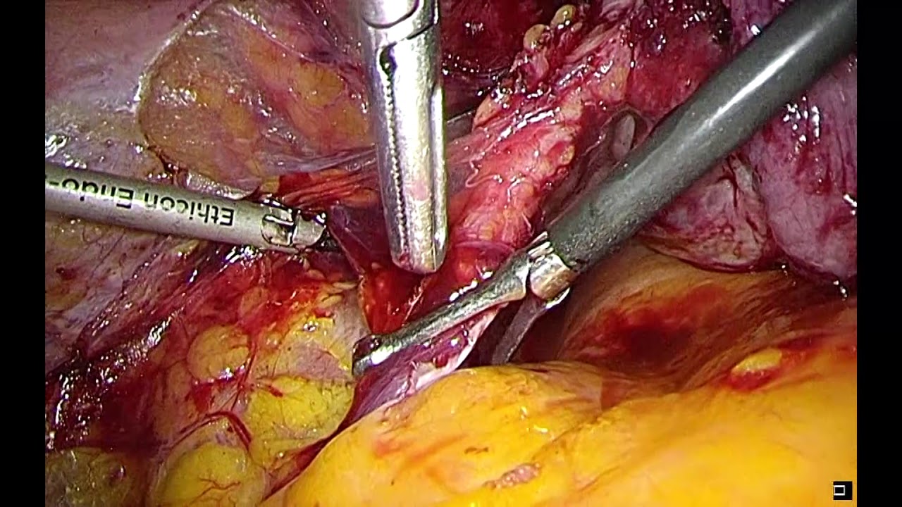 Radical resection of multifocal DIE in infertile patient - YouTube