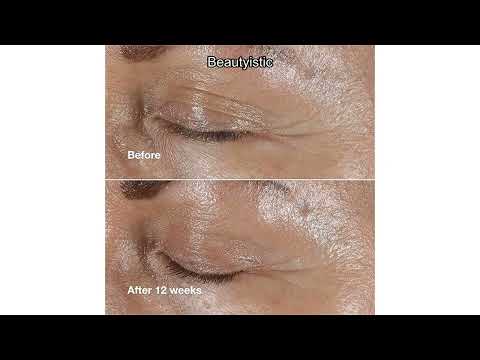 Clinique Smart Clinical Repair Eye Cream Review: Does It Really Combat Wrinkles & Puffiness?