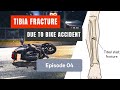 Tibia and Fibula fractured Ep. 04: 1st Doctor checkup, advice & improvements.