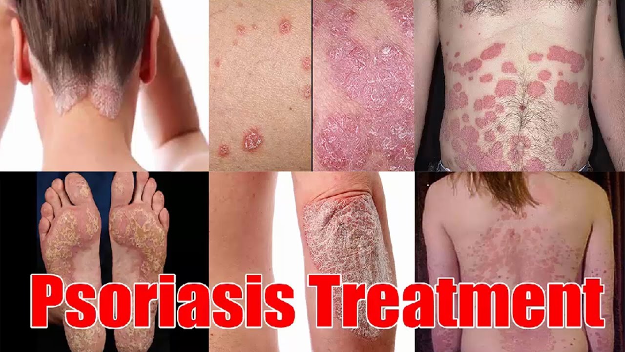 Treatment For Scalp Psoriasis - Natural Cure For Psoriasis Using Simple