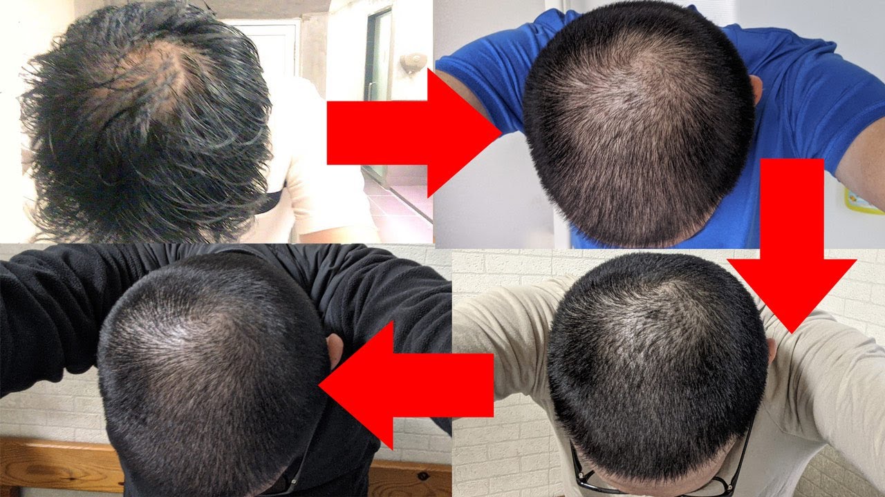 【効果なし？】AGA治療７ヶ月間の発毛結果＆正しい頭髪記録のとりかたとは？