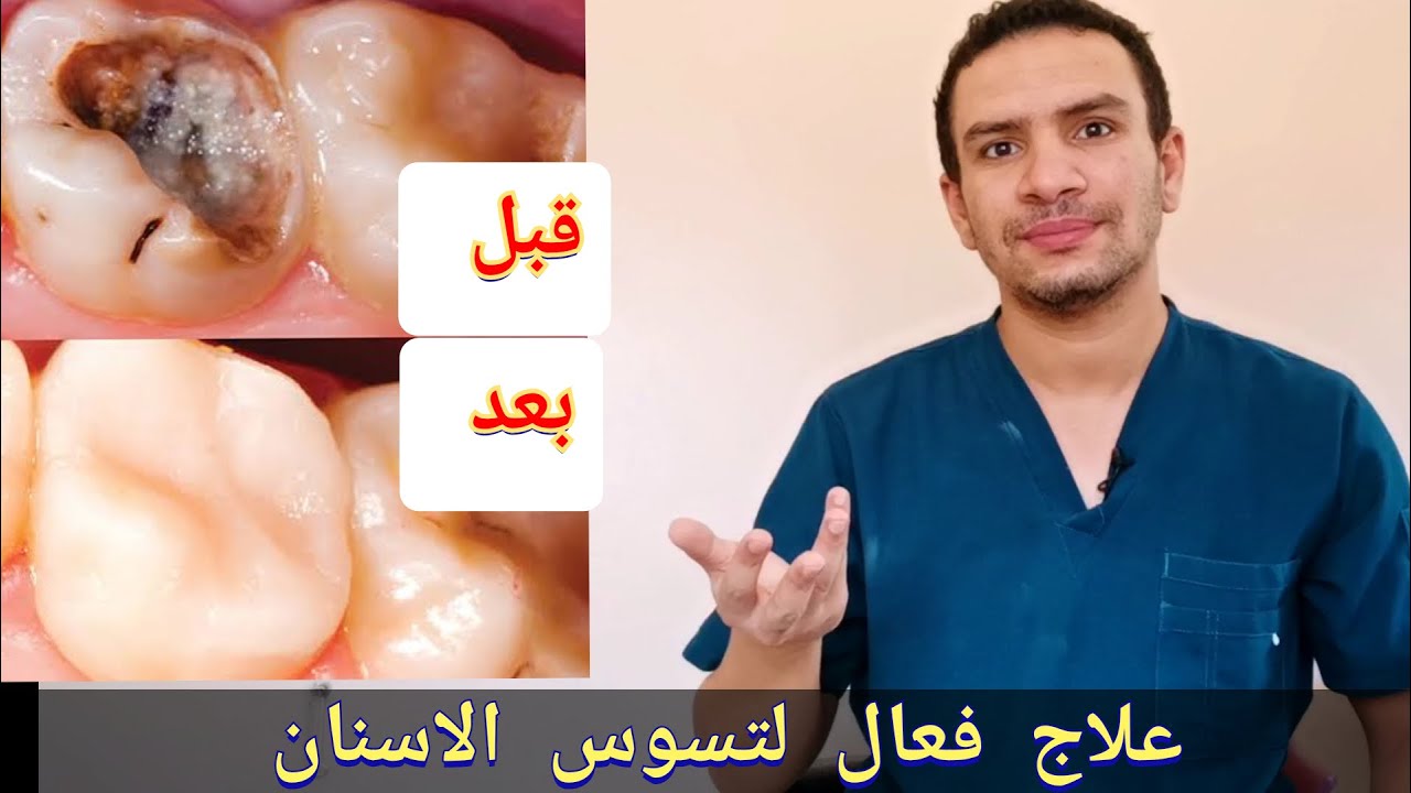 علاج لتسوس الاسنان في البيت بدون حشو هل ممكن!!