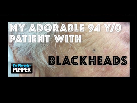 A Sweet Little 94 Year Old Woman Who Wants Her Blackheads Extracted