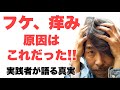 フケ 痒みの原因 湯シャン歴12年の理容師が語る知られざる事実