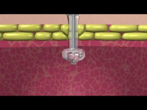 Minione Non Balloon Applied Medical Technology