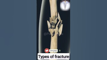 Types of fracture - 3D Animation Video   #shorts #youtubeshorts #fracture