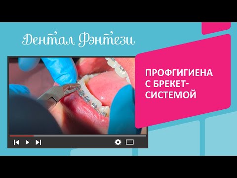 😬​ Профессиональная чистка зубов с брекет-системой