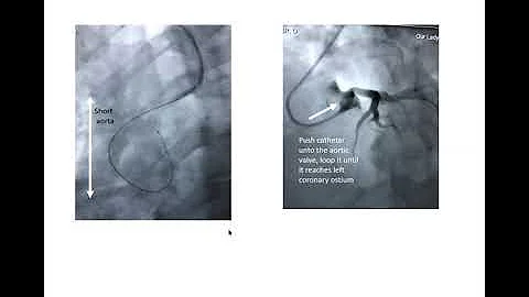 Coronary catheter techniques 1: focus on transradi...