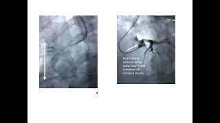 Coronary catheter techniques 1: focus on transradial approach- Elias Hanna, Univ Iowa