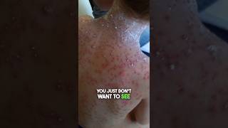 Chicken Pox: What It Looks Like and How to Treat It