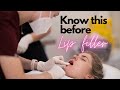 5 things to know before getting lip filler