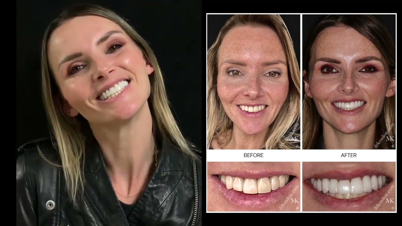 Transform Your Smile My Amazing Veneers Experience YouTube