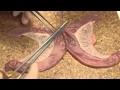 Side to side bowel anastomosis (simulated)