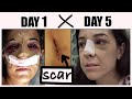 MY REVISION RHINOPLASTY EXPERIENCE IN TURKEY | nose job recovery (rib cartilage) WEEK 1 | Part 3