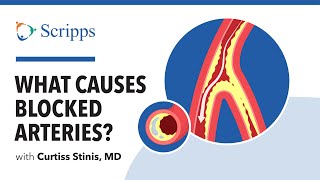 Coronary Artery Disease: Causes, Symptoms and Treatment with Dr. Curtiss Stinis | San Diego Health