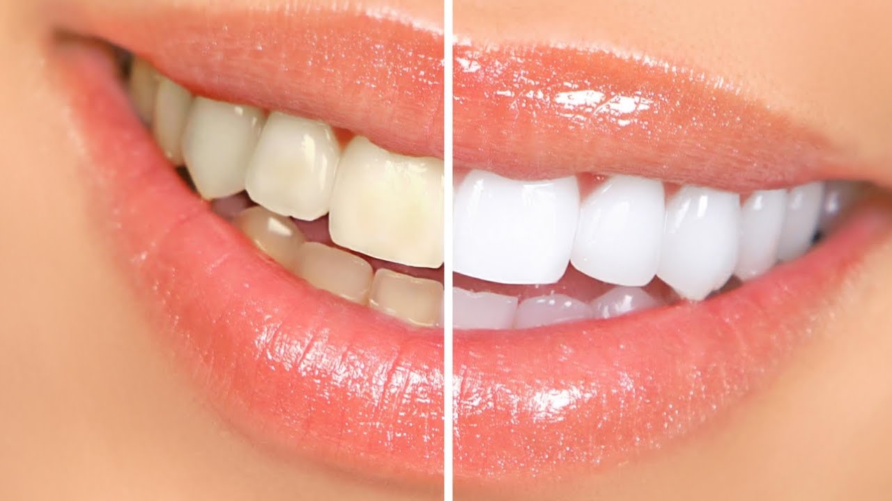 Make your teeth white again YouTube