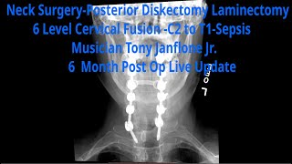 Neck Surgery-Posterior Diskectomy Laminectomy 6 Level Cervical Fusion -C2 to T1-Sepsis- Musician