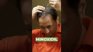 Dr. Agni, Dermatologist explains the real reason why minoxidil causes increased hair fall