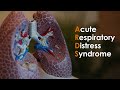 Acute Respiratory Distress Syndrome (ARDS) for USMLE Step1 and USMLE Step 2