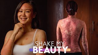 I’m Done Hiding My Psoriasis | SHAKE MY BEAUTY