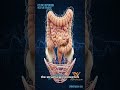 Hernia Causes DECODED: Mastering Clinical Concepts for Indian MD/MS & NEET PG#meded #mbbs #surgery