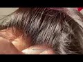 Frontal Swiss lace ... indetectable Hair replacement system ❤️